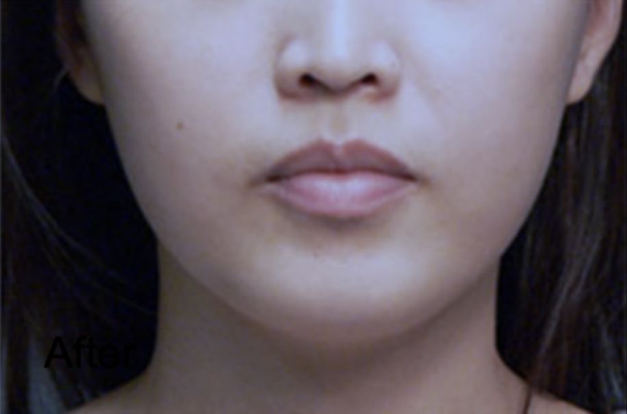 Botox Non-surgical Treatment for Face Slimming After