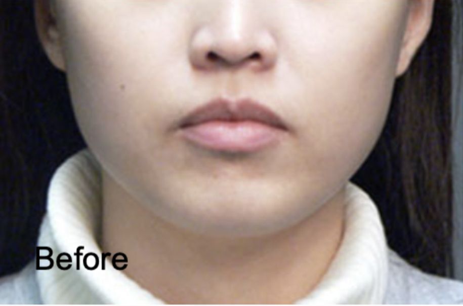 Botox Non-surgical Treatment for Face Slimming Before