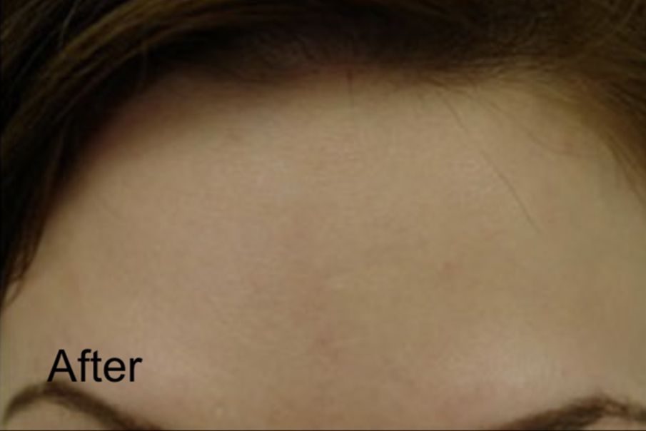 Neurotox Injections For Forehead Wrinkles After