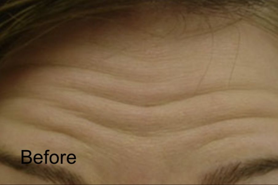 Botox Injections For Forehead Wrinkles Before