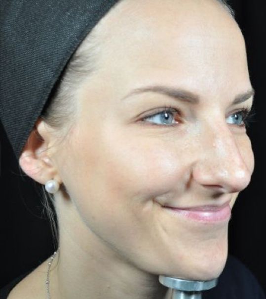 Baby Neurotox for Wrinkles After