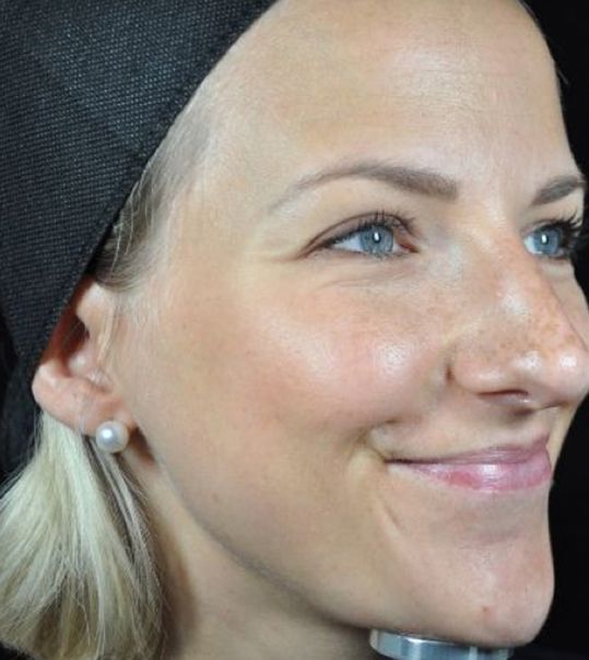 Baby Neurotox for Wrinkles Before