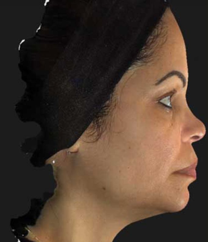 The Nefertiti Lift with Botox After
