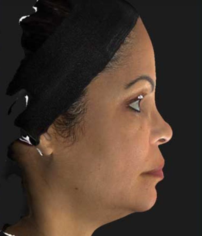 The Nefertiti Lift with Neurotox Before