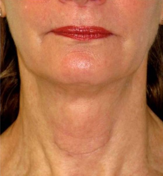 Botox for Turkey Neck Treatment  After