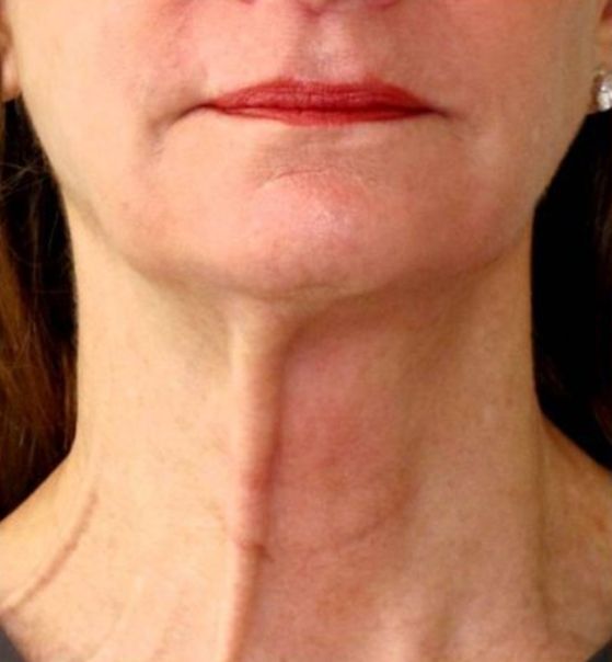 Neurotox for Turkey Neck Treatment  Before