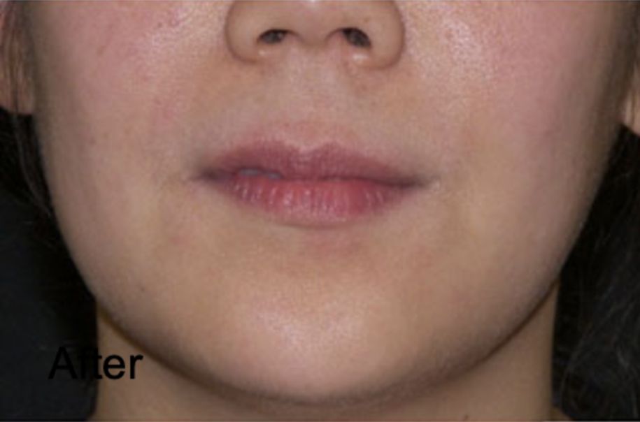 Neurotox for Facial Sculpting After