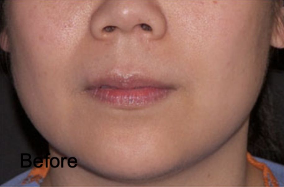 Neurotox for Facial Sculpting Before