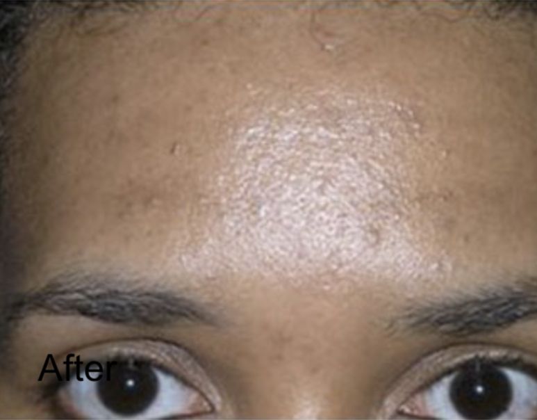 Neurotox For Forehead Fine Lines & Wrinkles After