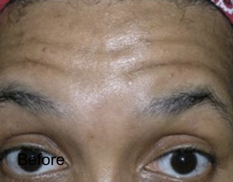 Botox For Forehead Fine Lines & Wrinkles Before