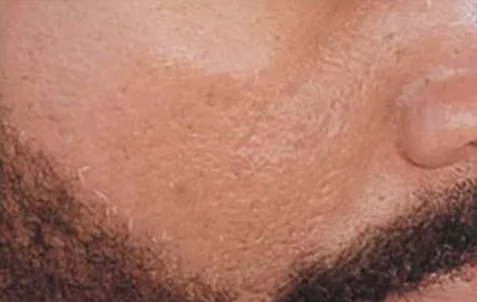 Neurotox for Large Pores & Acne - After