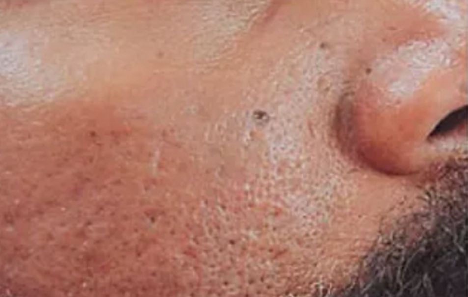 Neurotox for Large Pores & Acne - Before