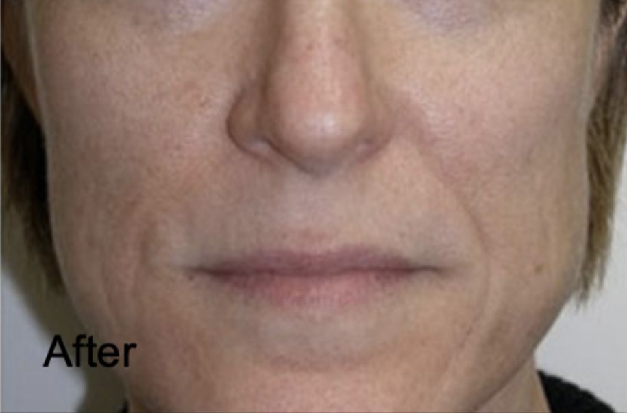 Neurotox for Slimmer Face After