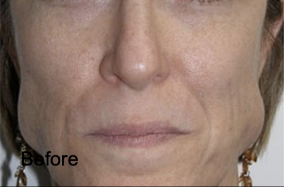 Botox for Slimmer Face Before