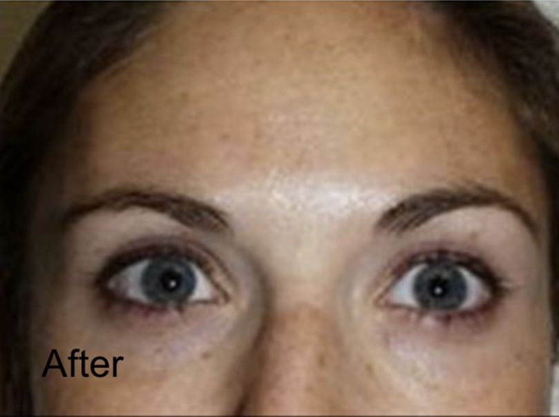 Botox to Combat Forehead Wrinkles After