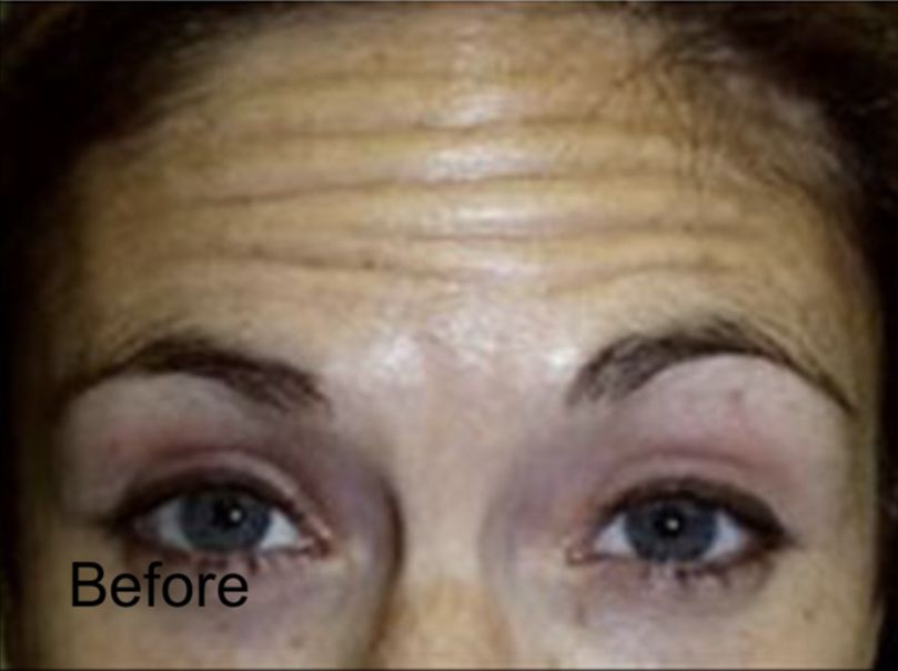 Botox to Combat Forehead Wrinkles Before