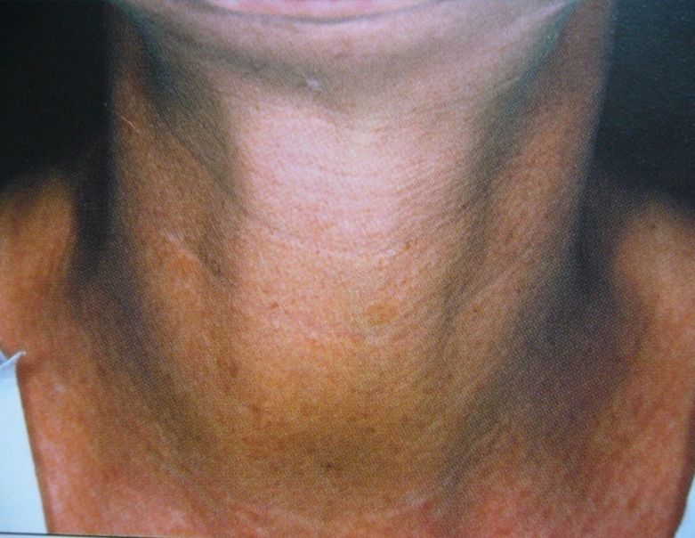 Neurotox Non-surgical Treatment for Turkey Neck After