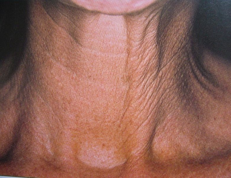 Botox Non-surgical Treatment for Turkey Neck Before