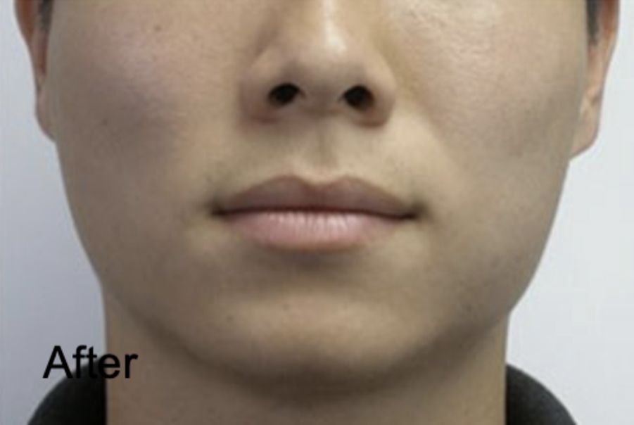 Botox for Male Slim Face After