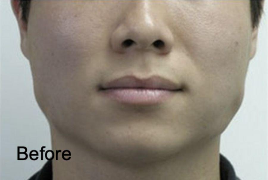 Botox for Male Slim Face Before