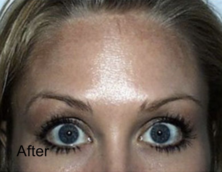 Botox  for  Forehead Rejuvenation After