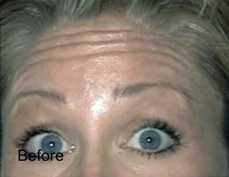 Botox  for  Forehead Rejuvenation Before