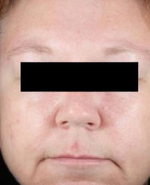 Botox for Pore-Less Skin After