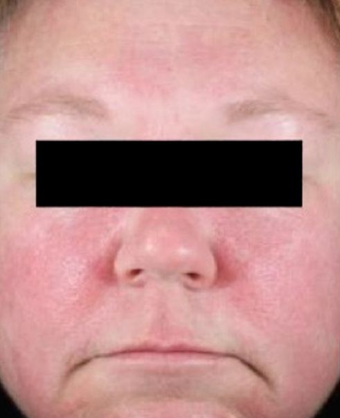 Botox for Pore-Less Skin Before