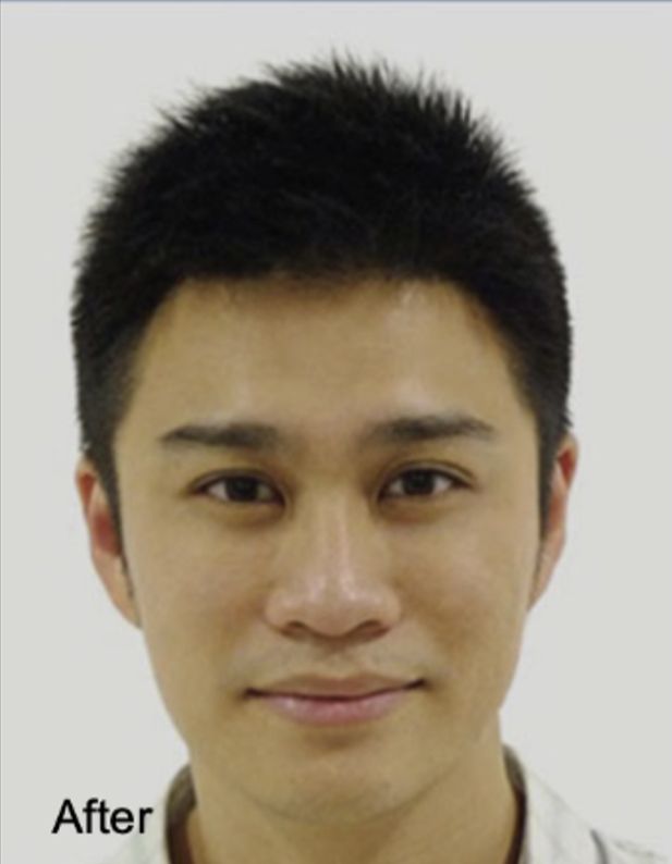 Neurotox Face Slimming After