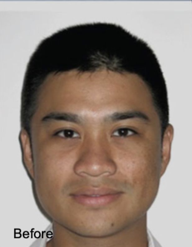 Botox Face Slimming Before