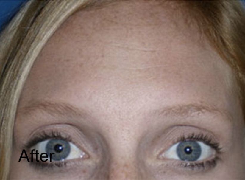 Forehead Lift with Neurotox Treatment After