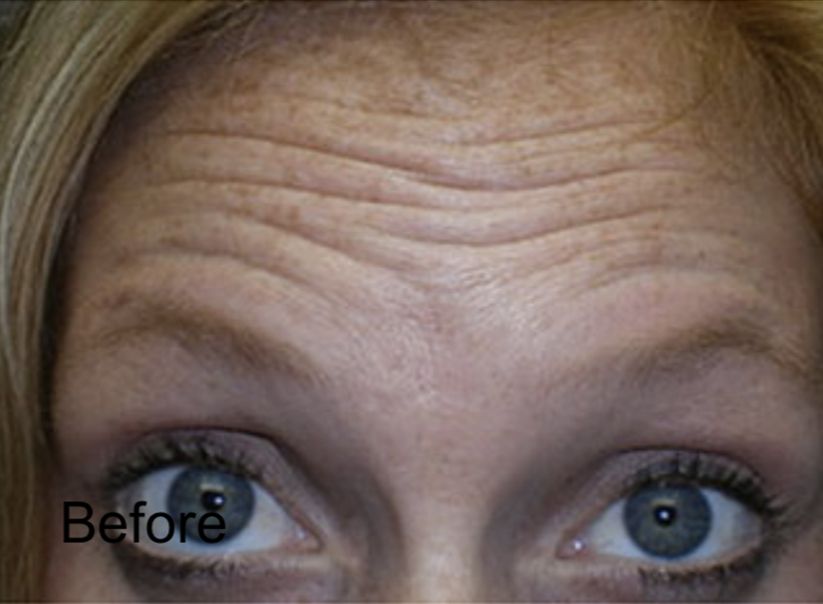 Forehead Lift with Botox Treatment Before