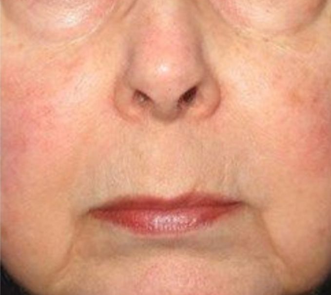 Botox to Shrink Pores  - After