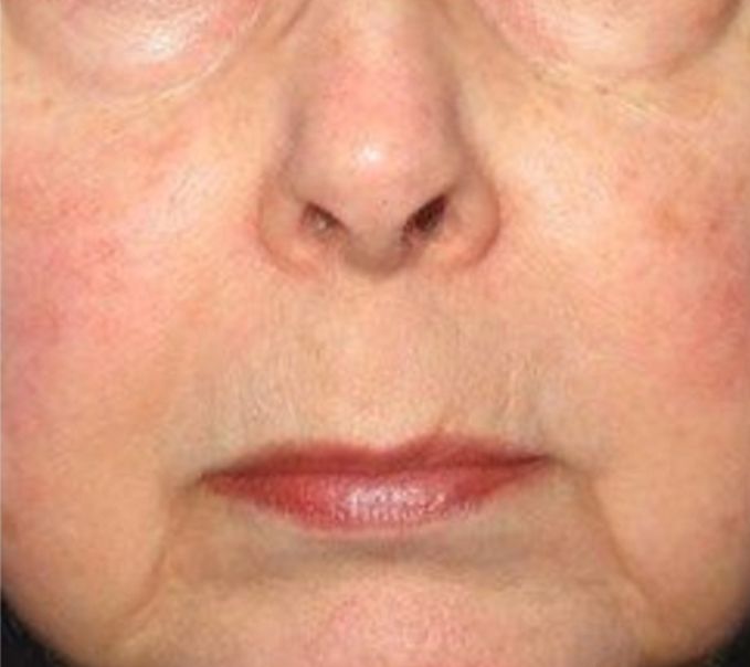 Neurotox to Shrink Pores  - After