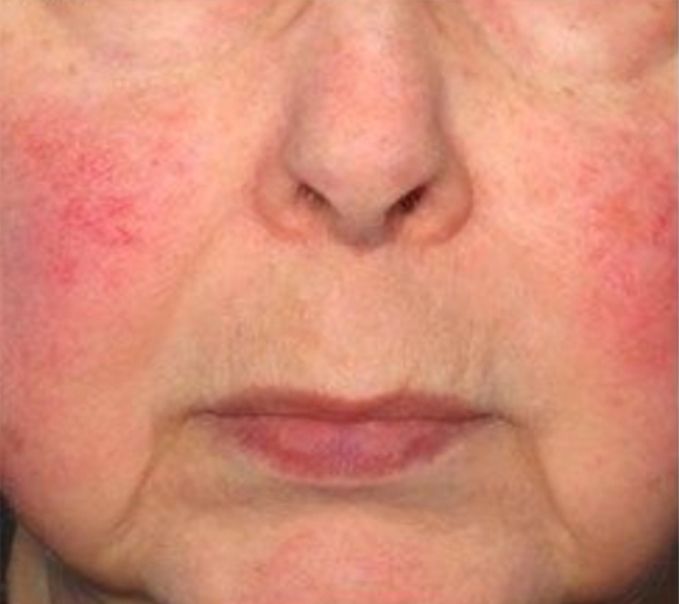 Neurotox to Shrink Pores - Before