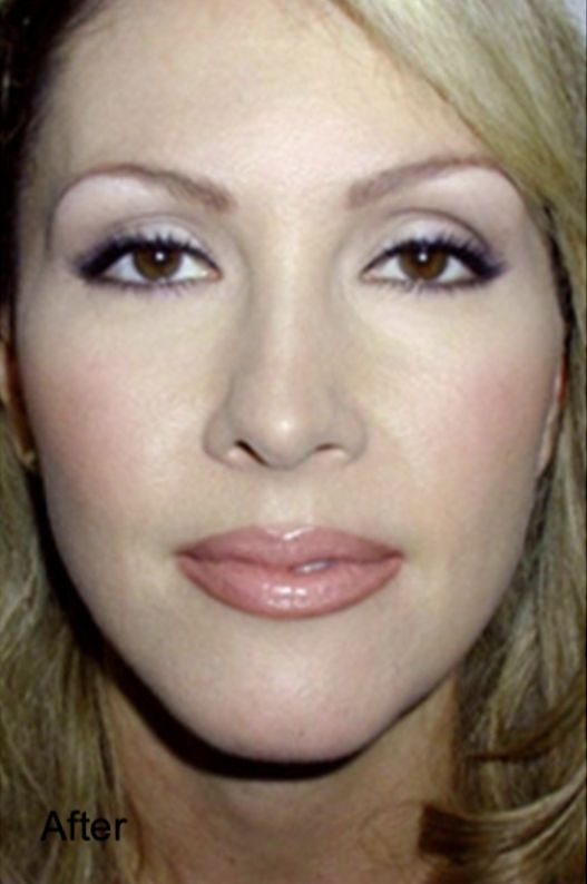 Neurotox for Face Slimming in Female After