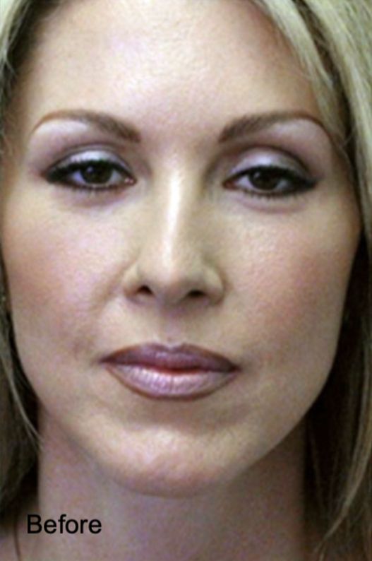 Neurotox for Face Slimming in Female Before