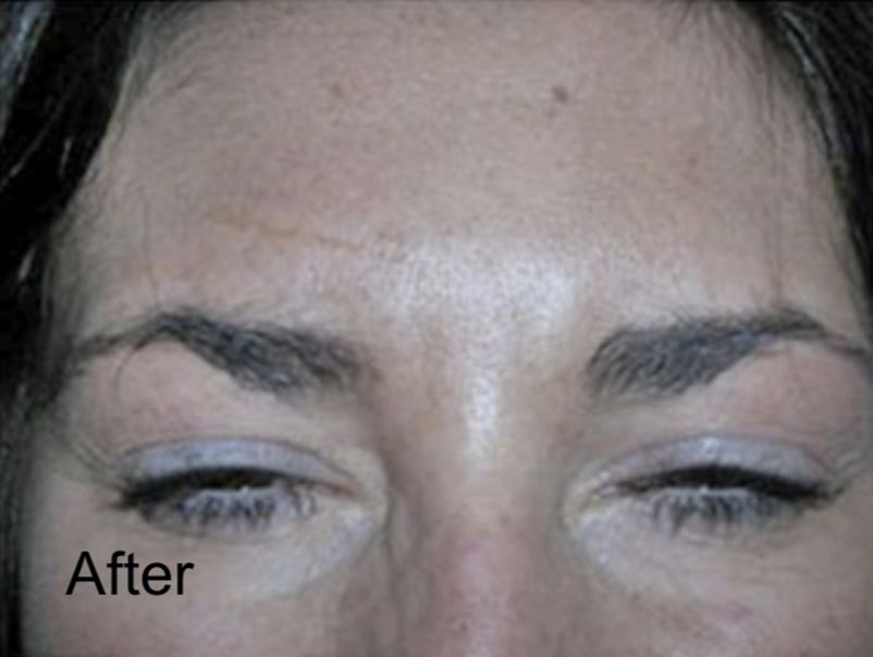 Eliminate Forehead Wrinkles with Botox -After