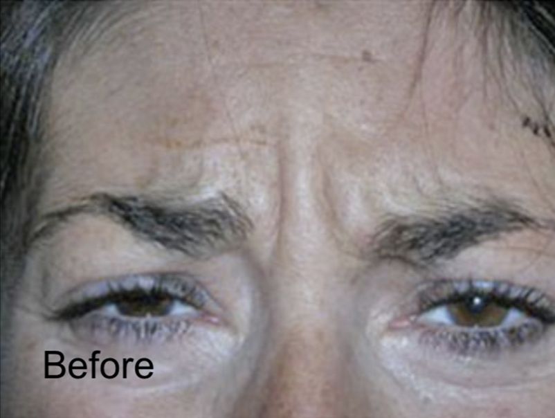 Eliminate Forehead Wrinkles with Neurotox - Before
