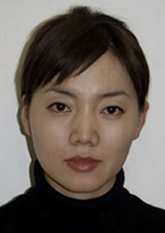 Neurotox Face-Slimming Treatment After