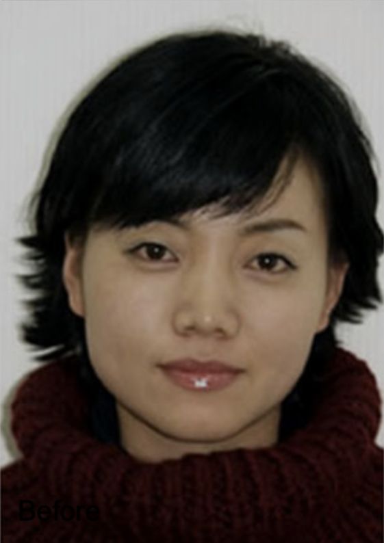 Neurotox Face-Slimming Treatment Before