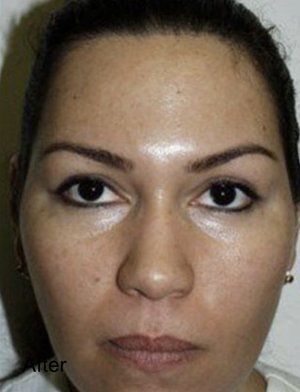 Neurotox for Frown Lines After