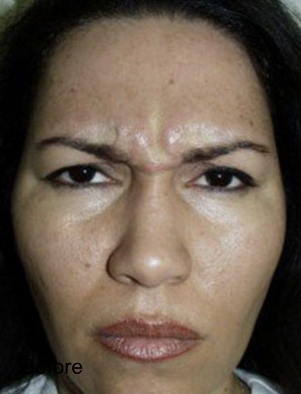 Botox for Frown Lines Before