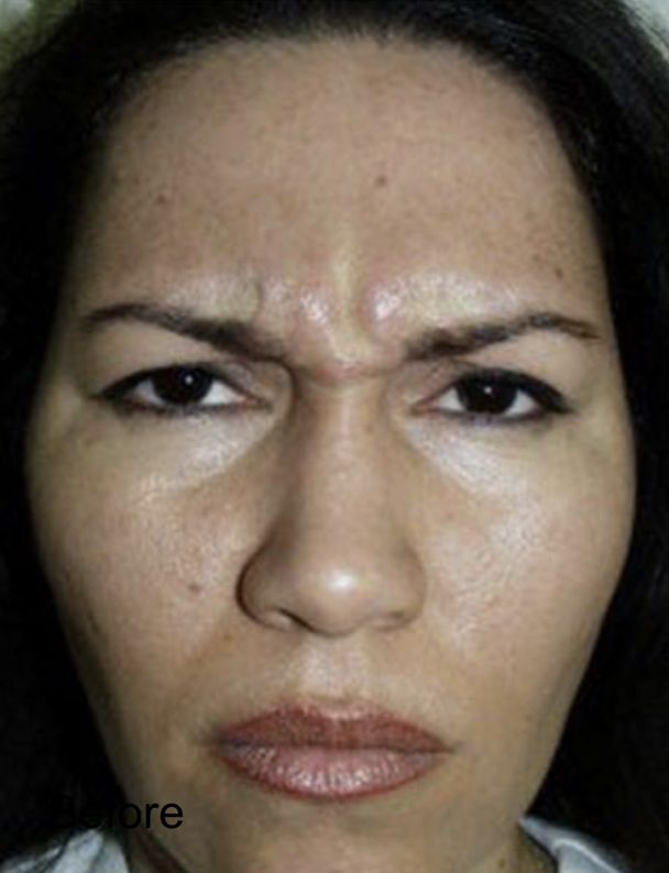 Neurotox for Frown Lines Before