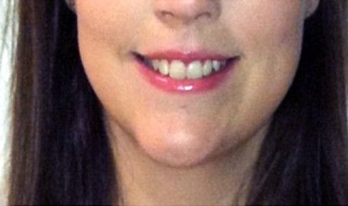 Botox For Gummy Smile  After