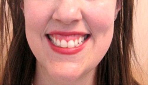 Botox For Gummy Smile  Before