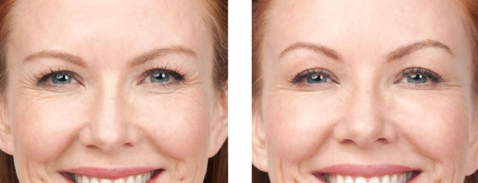 Crows feet