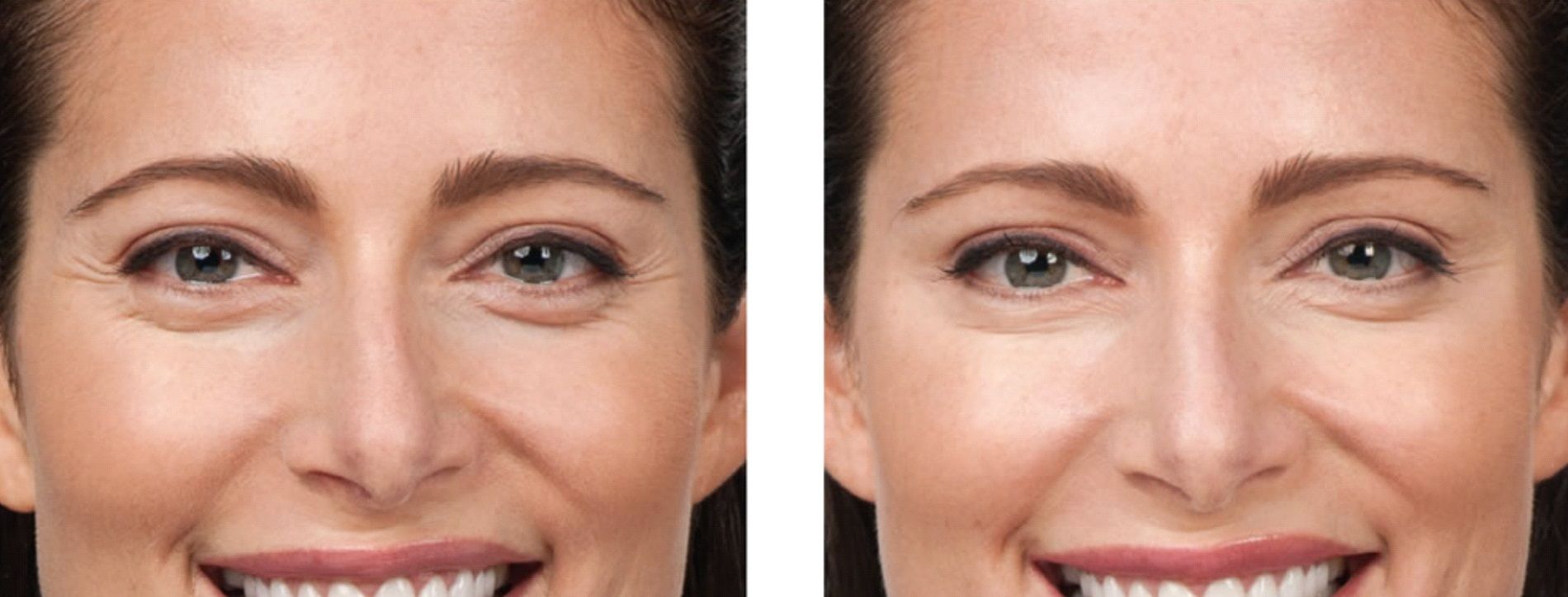 Crows Feet