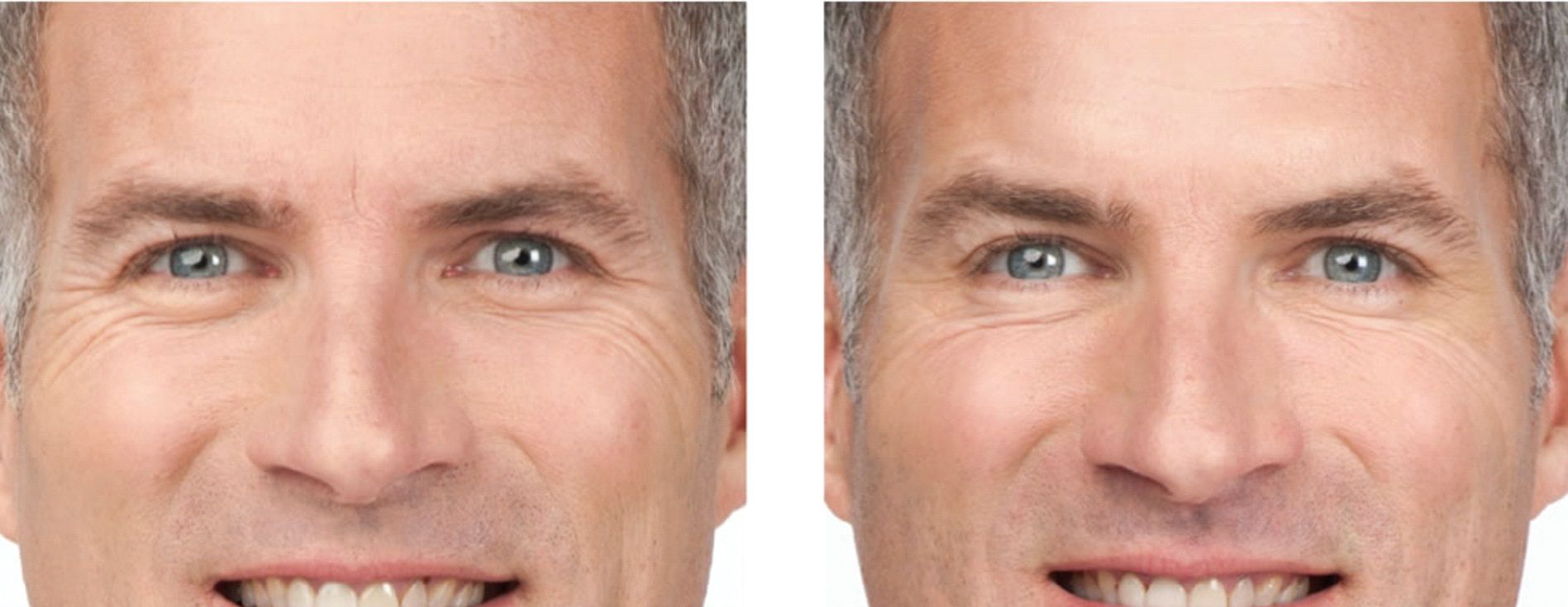 Crows Feet