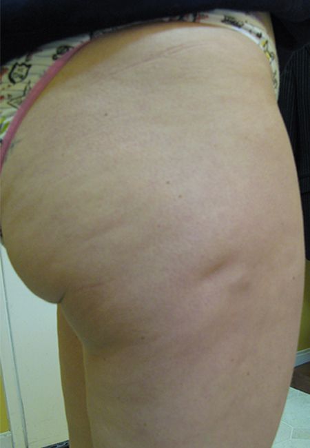 Cellulite Treatment For Buttocks - Before